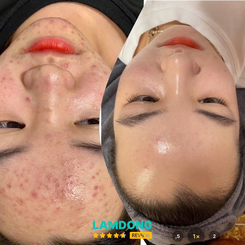 Hà Nguyễn Spa & Clinic Beauty – chăm sóc da mụn